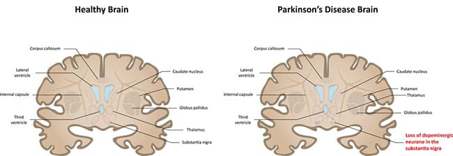 Đang tải parkinson brain_1.jpg…