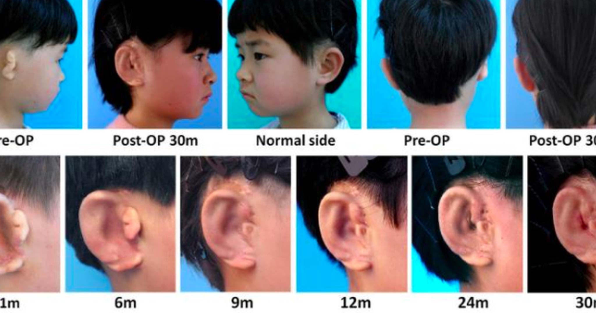 Dùng kỹ thuật in 3D, các nhà khoa học đã giúp những đứa trẻ bị dị tật bẩm sinh "mọc lại tai"