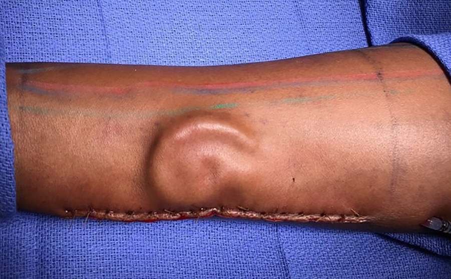 Bác sĩ Mỹ cấy thành công tai nhân tạo được nuôi dưỡng dưới cánh tay của bệnh nhân
