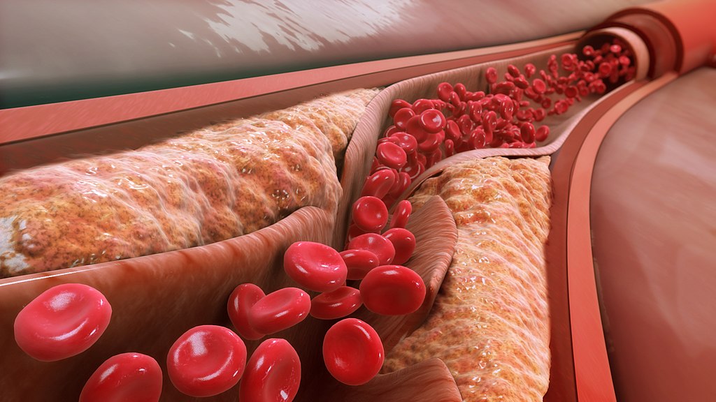 Đang tải LDL causes the progression of atherosclerosis and blocks the artery lumen.jpg…