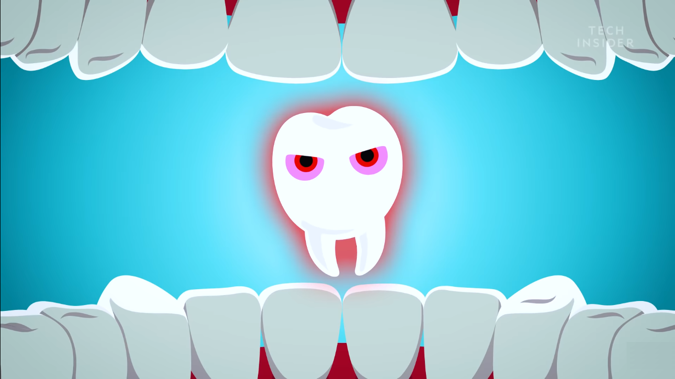 [Có thể bạn chưa biết] Tại sao răng khôn lại cực ngu?