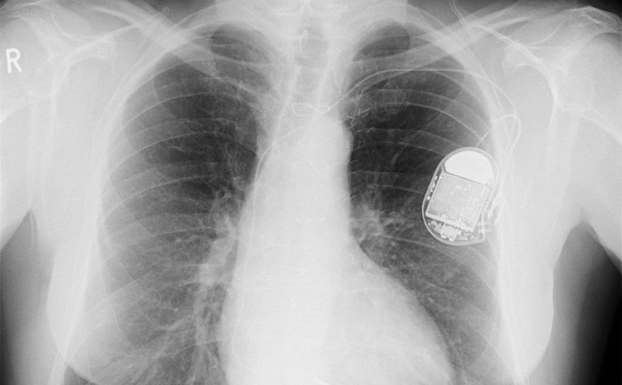 Lỗi nghiêm trọng cho phép hacker kiểm soát máy khử rung tim trong cơ thể bệnh nhân