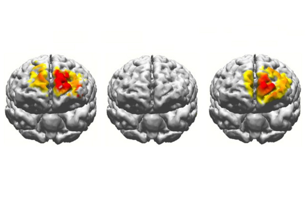 Kích thích điện vào não người cao tuổi để giúp có khả năng nhớ như của thanh niên