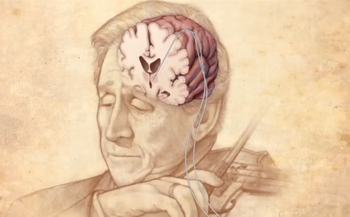 Một nghệ sỹ violin trực tiếp chơi nhạc ngay trong quá trình phẫu thuật não