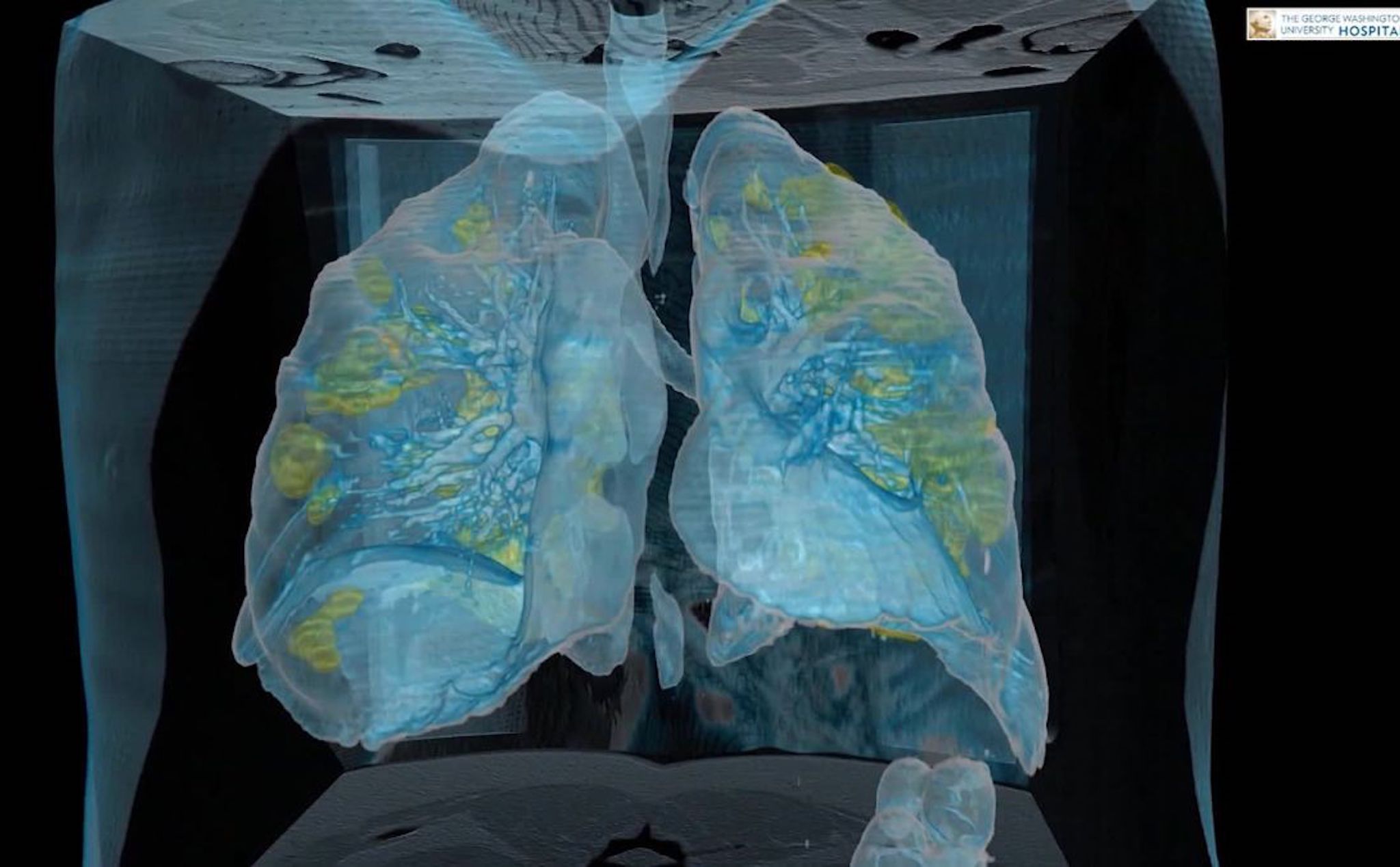 Nếu không ở nhà thì có thể đây sẽ là hình ảnh lá phổi của bạn