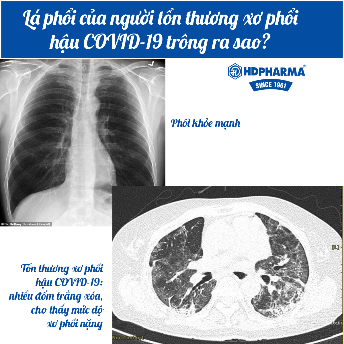 KHÓ THỞ SAU KHI KHỎI COVID-19, PHẢI LÀM SAO?