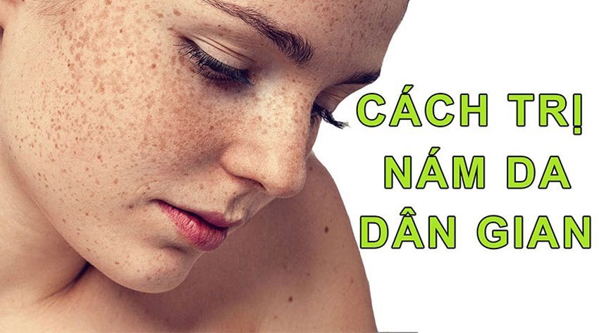 Cách trị nám da tại nhà an toàn hiệu quả cho chị em