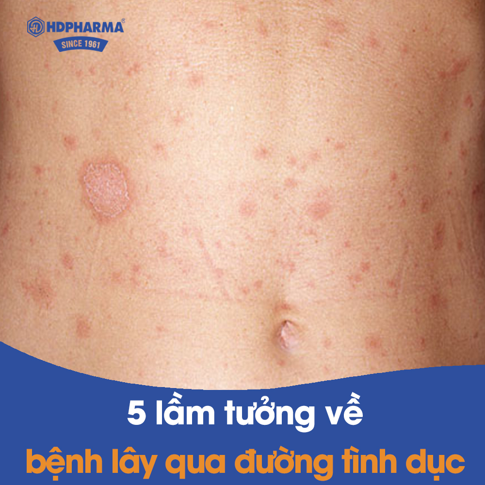 Có thể bạn chưa biết: 05 lầm tưởng về bệnh lây qua đường tình dục