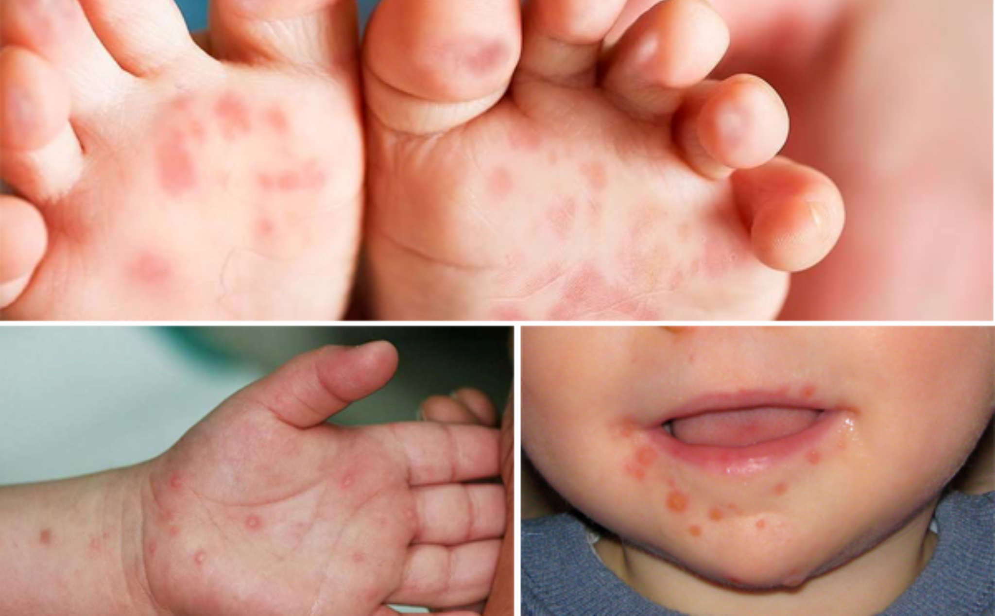 Số trẻ bị tay chân miệng tại TPHCM tăng gấp 4 lần so với tháng trước, cảnh báo bùng dịch