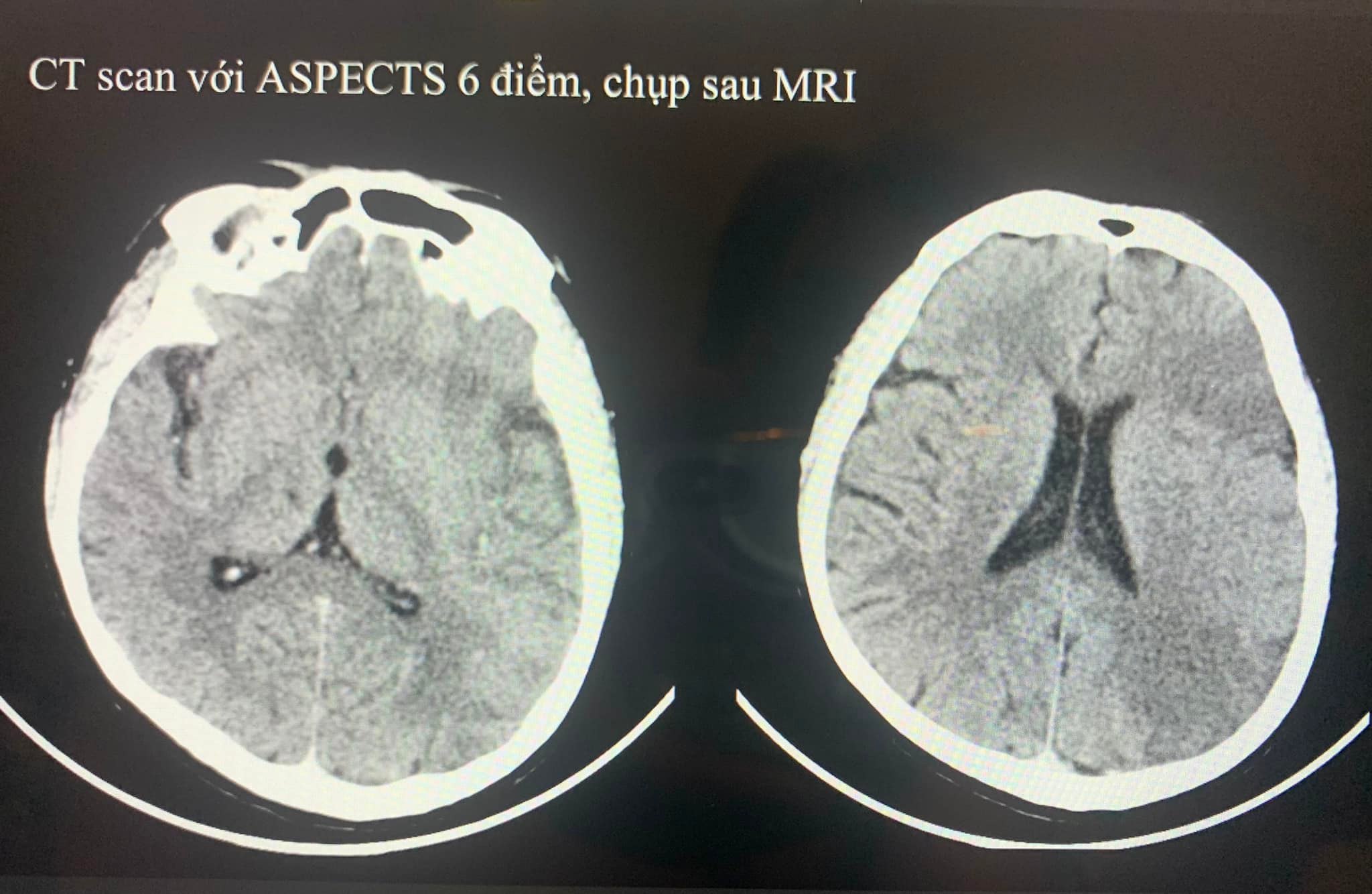 CT Scan và MRI trong đột quỵ tối cấp.