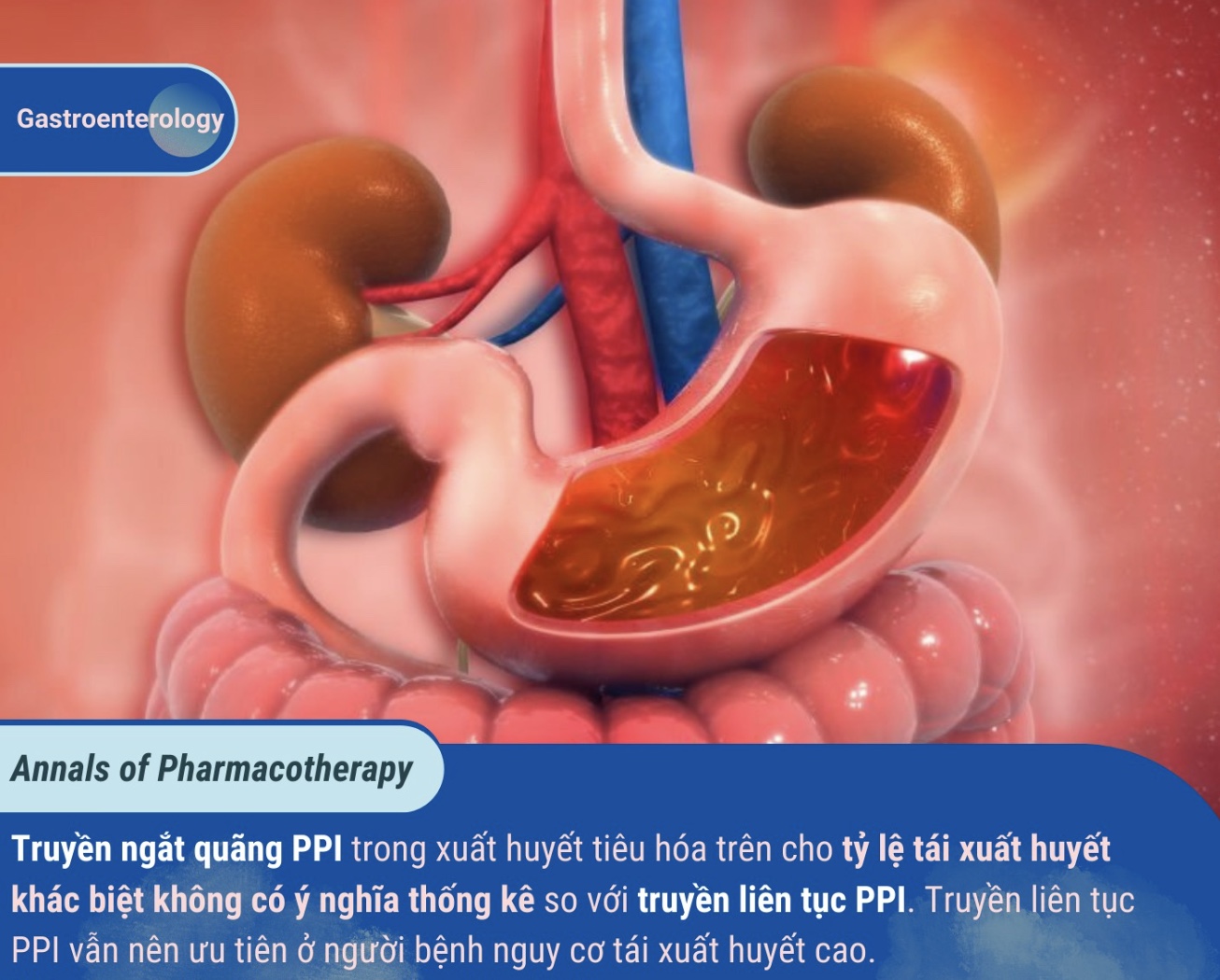 SO SÁNH PHÁC ĐỒ TRUYỀN NGẮT QUÃNG VỚI  TRUYỀN LIÊN TỤC PPI Ở NGƯỜI BỆNH XUẤT HUYẾT TIÊU HÓA TRÊN