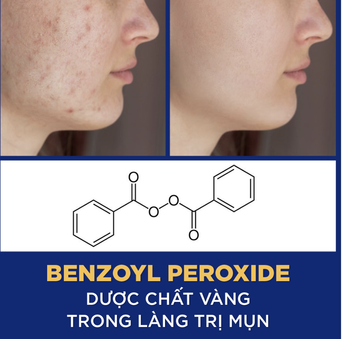 BENZOYL PEROXIDE - DƯỢC CHẤT VÀNG TRONG LÀNG TRỊ MỤN