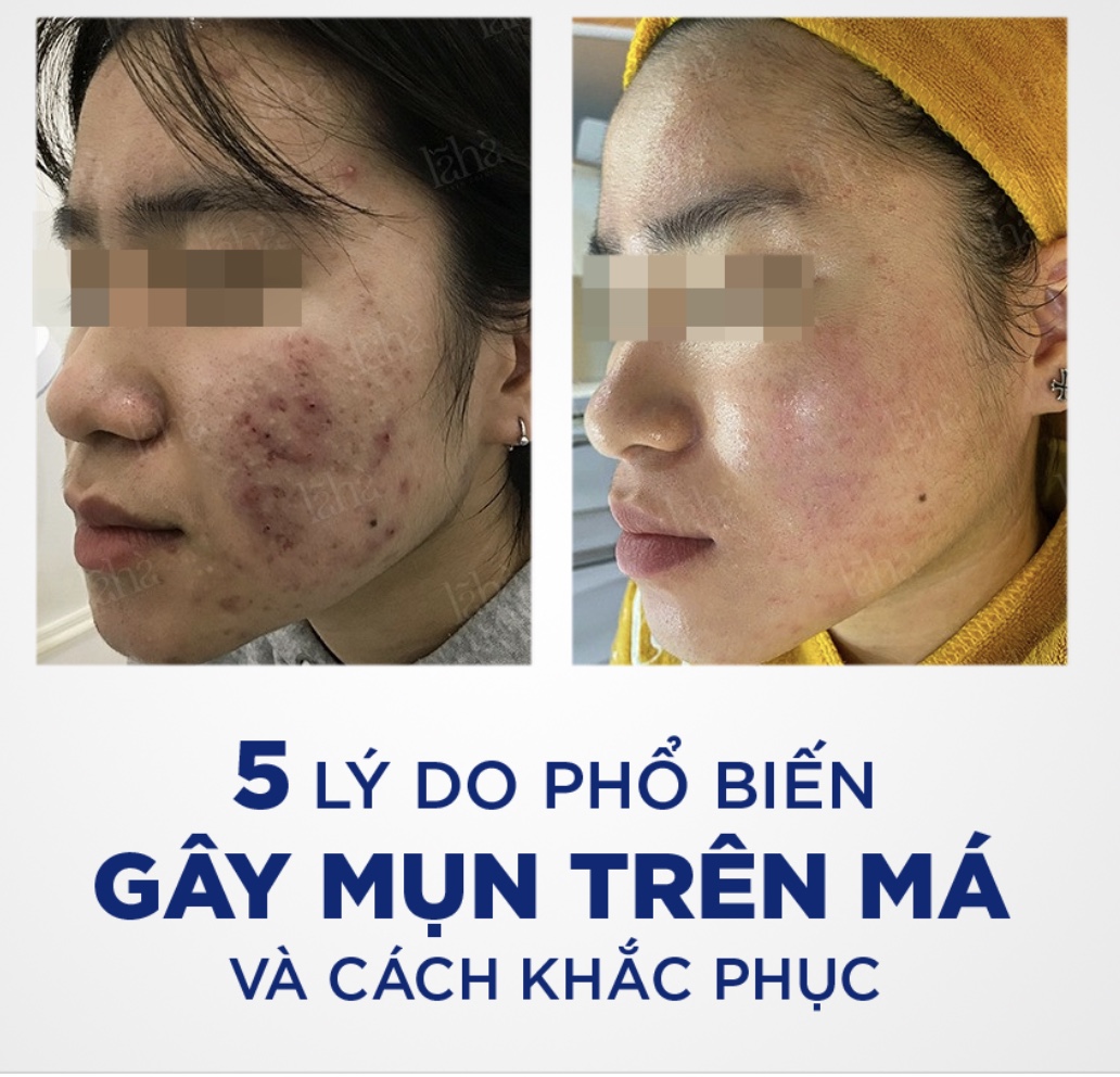 5 LÝ DO VÌ SAO TÌNH TRẠNG MỤN Ở MÁ MÃI KHÔNG CHẤM DỨT