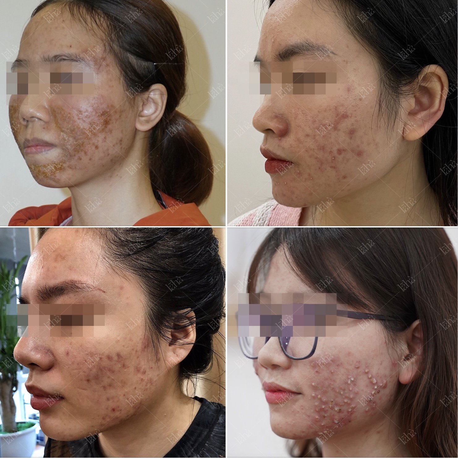 CÓ PHẢI TREATMENT (BHA, RETINOL, TRETINOIN...) LÚC NÀO CŨNG TỐT CHO DA MỤN?