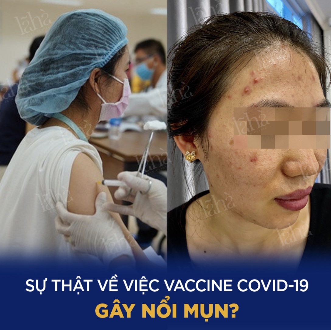 SỰ THẬT VỀ VIỆC VACCINE COVID-19 GÂY NỔI MỤN?