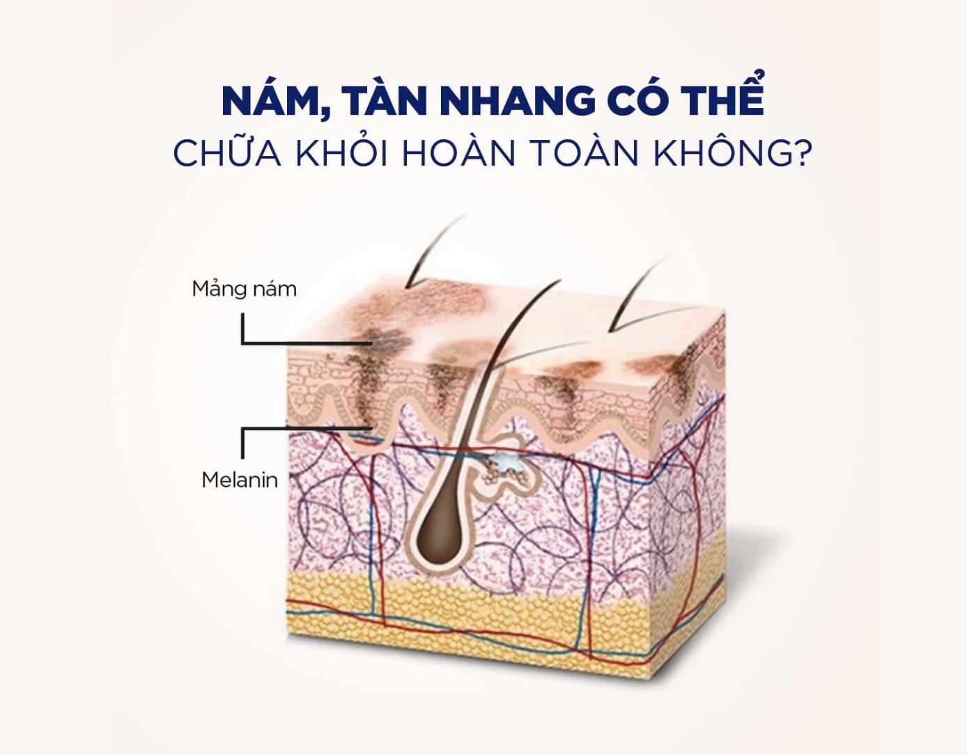 “NỖI OAN” CỦA MELANIN VÀ CÂU HỎI MUÔN THUỞ: “NÁM, TÀN NHANG CÓ THỂ CHỮA KHỎI HOÀN TOÀN KHÔNG?”