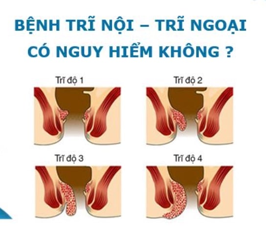 BỆNH TRĨ CÓ NGUY HIỂM KHÔNG?