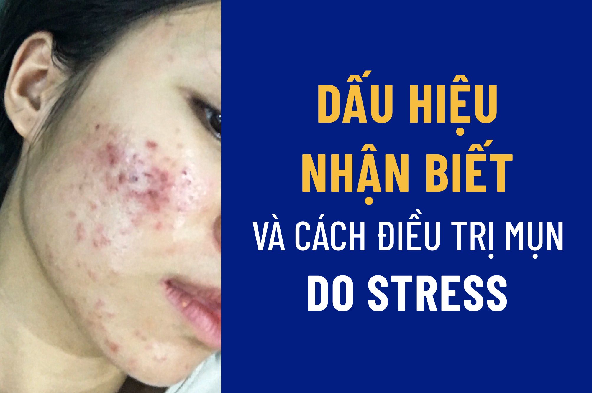 MỤN DO STRESS - “ÁC MỘNG” CỦA NGƯỜI TRẺ?