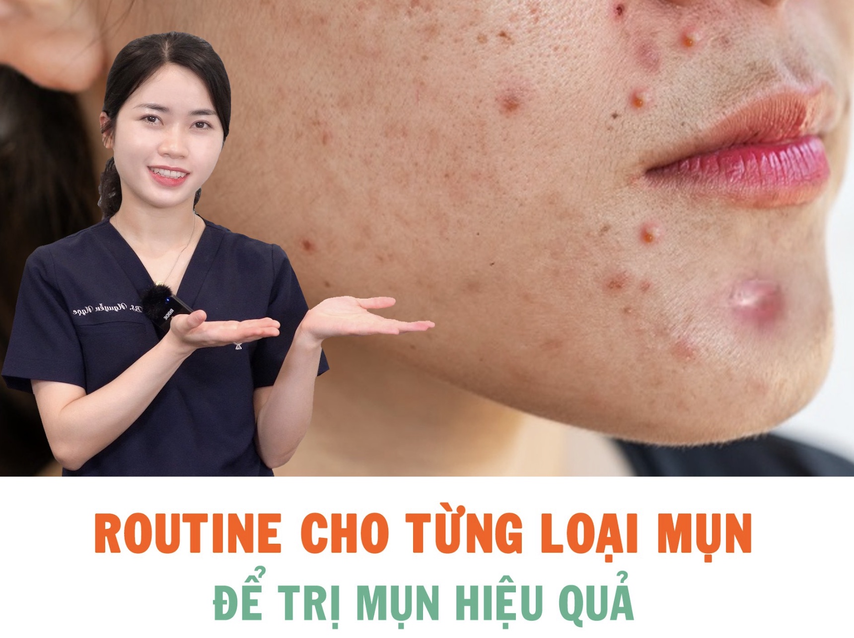 ROUTINE CHO TỪNG LOẠI MỤN ĐỂ TRỊ MỤN HIỆU QUẢ