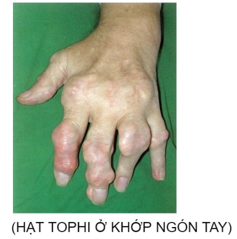 4 GIAI ĐOẠN CỦA GOUT