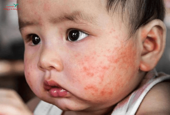 Trẻ sơ sinh nổi mẩn đỏ sau khi sốt phải làm sao