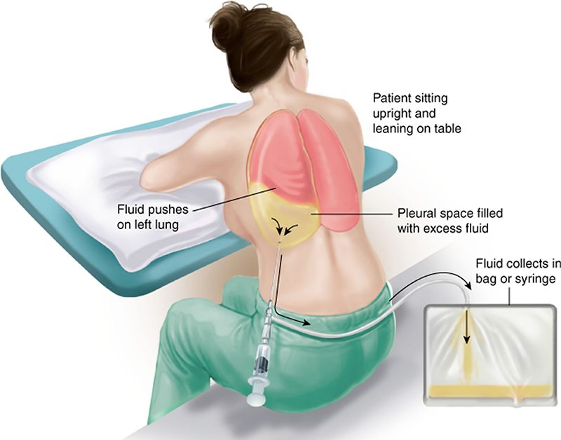 Vì sao khi chọc tháo dịch màng phổi chỉ nên lấy ≤ 1 lít/lần ?