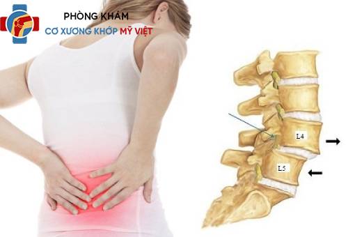 Xẹp Đốt Sống L4-L5: Nguyên Nhân, Triệu Chứng và Phương Pháp Điều Trị Hiệu Quả