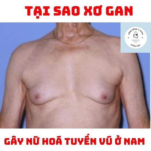 TẠI SAO XƠ GAN CÓ THỂ GÂY NỮ HÓA TUYẾN VÚ Ở NAM?