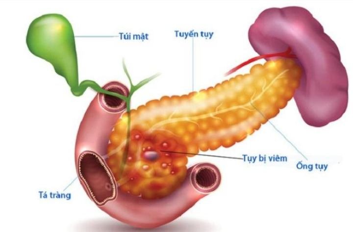 Tại sao viêm tụy cấp lại gây nên tràn dịch màng phổi ?