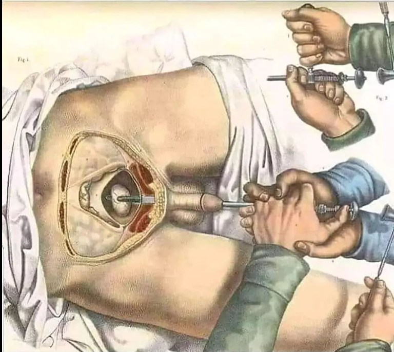 LITHOTOMY (TÁN SỎI, LẤY SỎI)