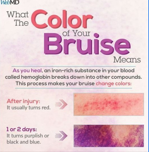 SINH LÝ VẾT BẦM (Bruise)