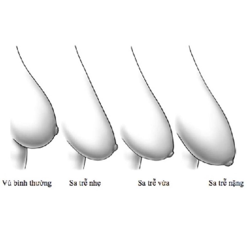 Chủ đề sa trễ ngực