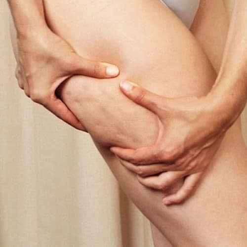 DA SẦN VỎ CAM (CELLULITE) – Kẻ thù thầm lặng của những chiếc váy ngắn  tại Lux đang giảm 50%