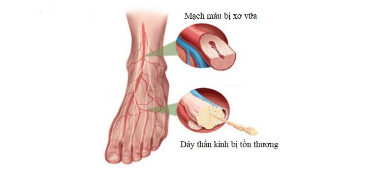 VÌ SAO ĐÁI THÁO ĐƯỜNG GÂY LOÉT BÀN CHÂN ?