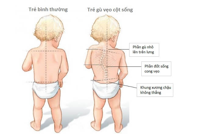 Trẻ sơ sinh bị gù lưng rất khó để bố mẹ có thể nhận biết ngay từ đầu. Khi không được phát hiện...