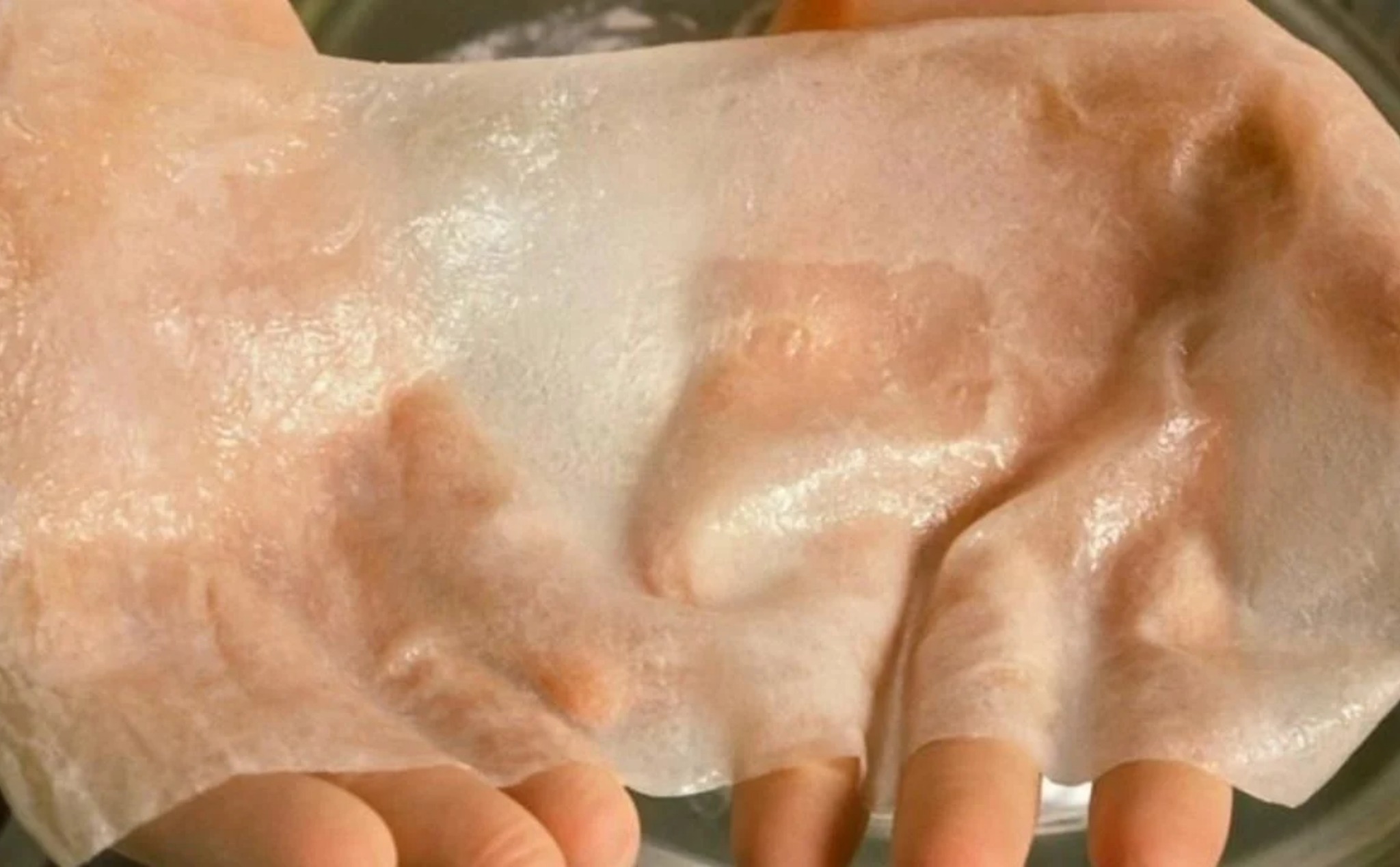 Nghiên cứu in sinh học 3D da để sử dụng cho những nạn nhân bị bỏng