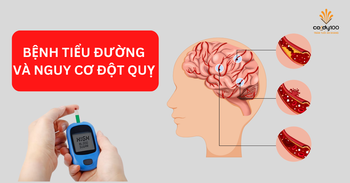 Bệnh tiểu đường và nguy cơ bị đột quỵ